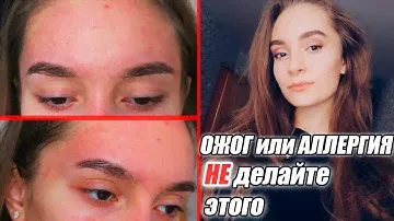 ОЖОГ или АЛЛЕРГИЯ? Что произошло с моим лицом? | DNC гель с алоэ вера